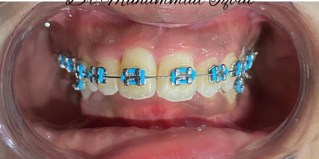 After 4 months with braces