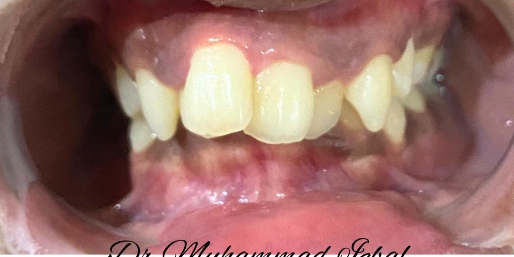 Before braces