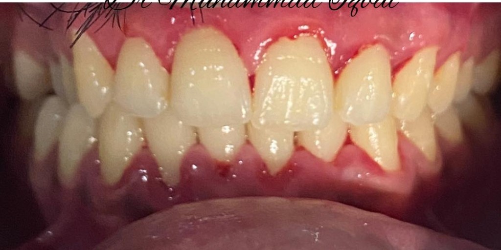 After Treatment