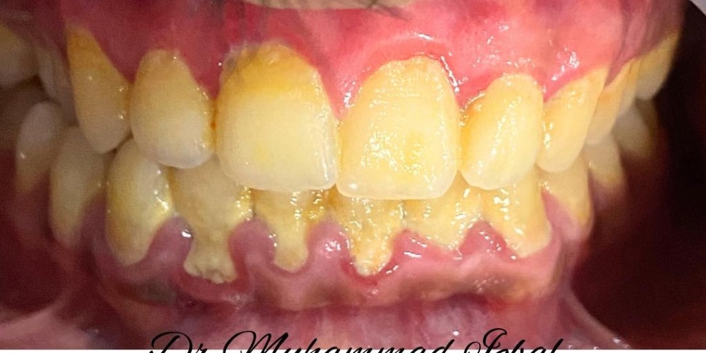 Before Treatment