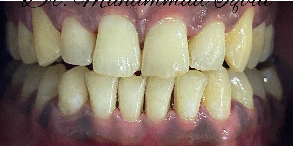 After treatment