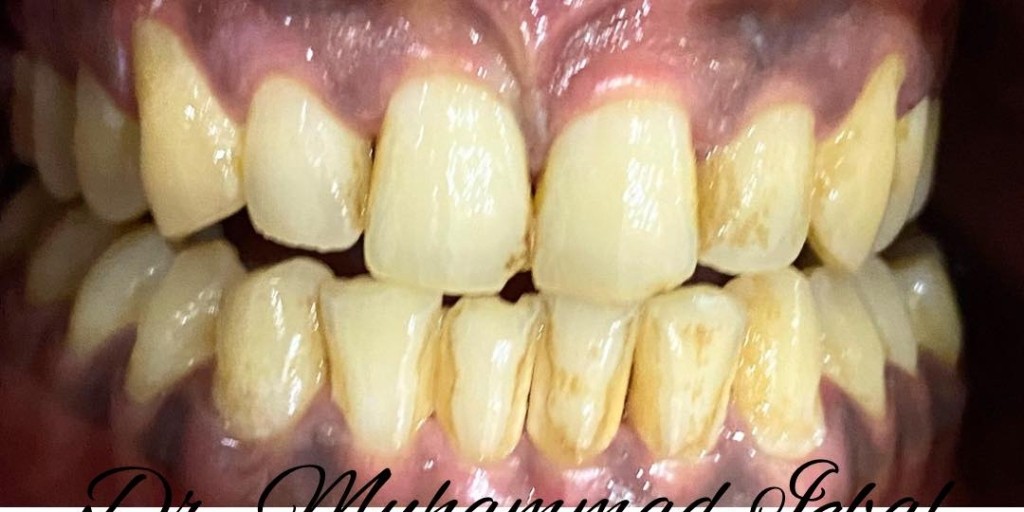 Before treatment